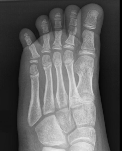 File:5th toe fracture - Salter-Harris type II (Radiopaedia 67151-76491 Oblique 1).JPEG