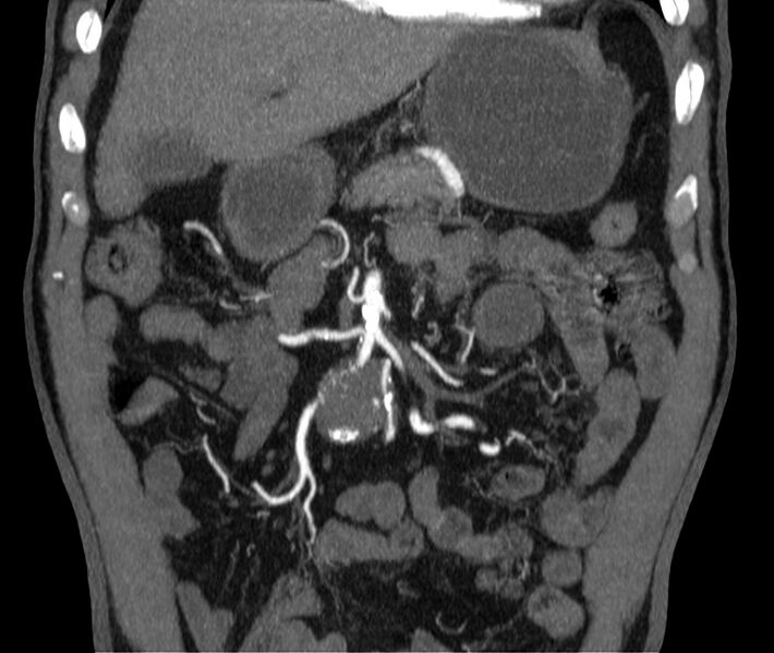 File:Abdominal aortic aneurysm (Radiopaedia 22421-22458 C 8).jpg