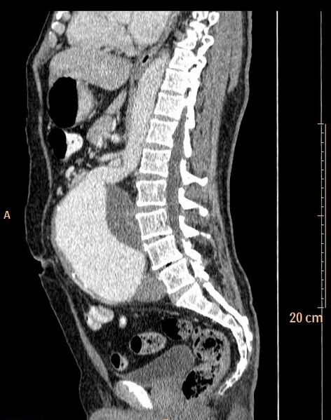 File:Abdominal aortic aneurysm (Radiopaedia 25985-26121 Sagittal C+ arterial phase 14).jpg