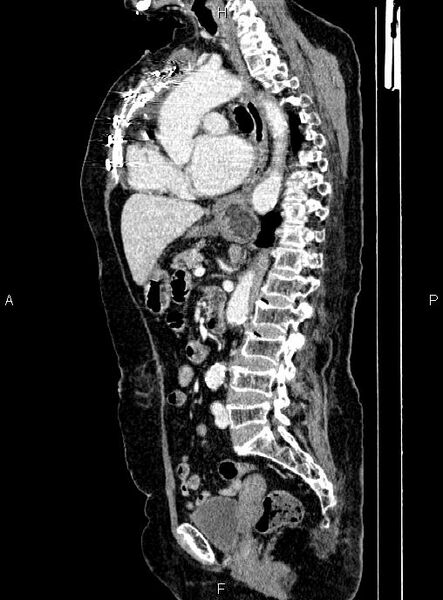 File:Abdominal aortic aneurysm (Radiopaedia 85063-100606 Sagittal C+ arterial phase 44).jpg