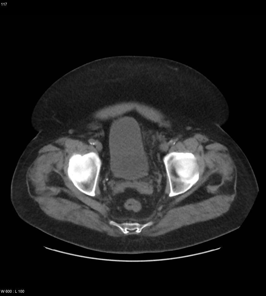 Abdominal aortic aneurysm with intramural hematoma then rupture (Radiopaedia 50278-55631 Axial non-contrast 113).jpg