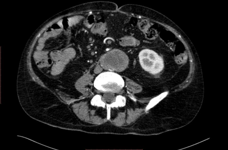 File:Abdominal aortic interposition tube graft and aneurysm thrombosis (Radiopaedia 71438-81857 Axial C+ arterial phase 109).jpg