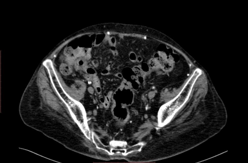 File:Abdominal aortic interposition tube graft and aneurysm thrombosis (Radiopaedia 71438-81857 Axial C+ arterial phase 183).jpg