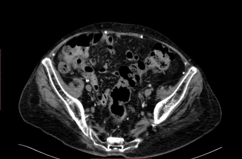 Abdominal aortic interposition tube graft and aneurysm thrombosis (Radiopaedia 71438-81857 Axial C+ arterial phase 183).jpg