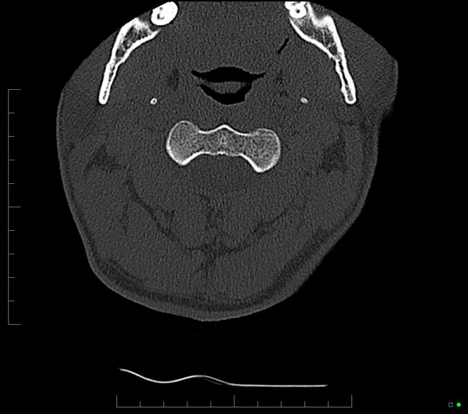 File:Accessory articulation of cervical transverse processes (Radiopaedia 82715-96933 Axial non-contrast 30).jpg