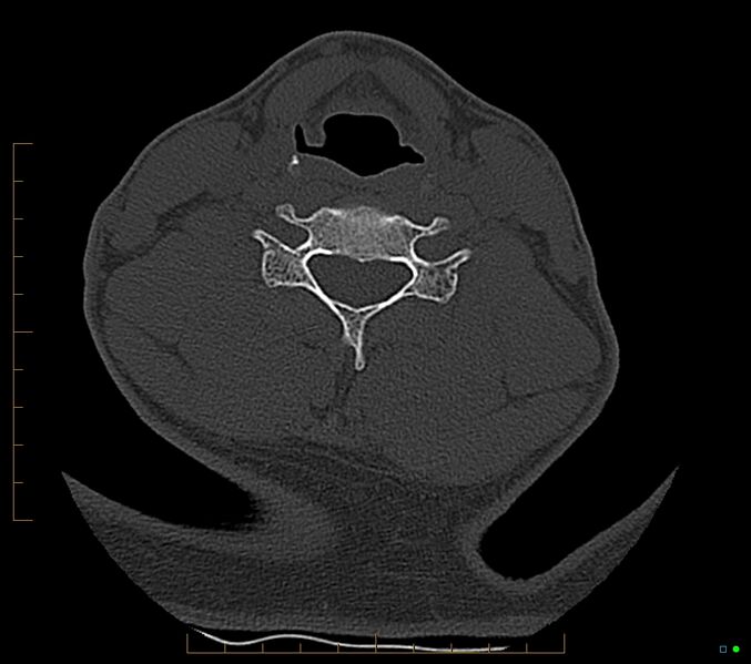 File:Accessory articulation of cervical transverse processes (Radiopaedia 82715-96933 Axial non-contrast 83).jpg