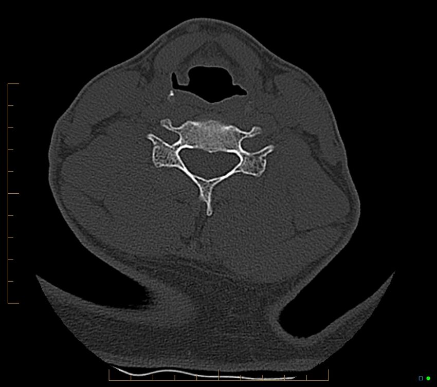 Accessory articulation of cervical transverse processes (Radiopaedia 82715-96933 Axial non-contrast 83).jpg