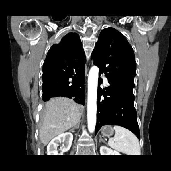 File:Acquired adrenal hyperplasia - due to thymic carcinoid tumor (Radiopaedia 21269-21184 C 7).jpg