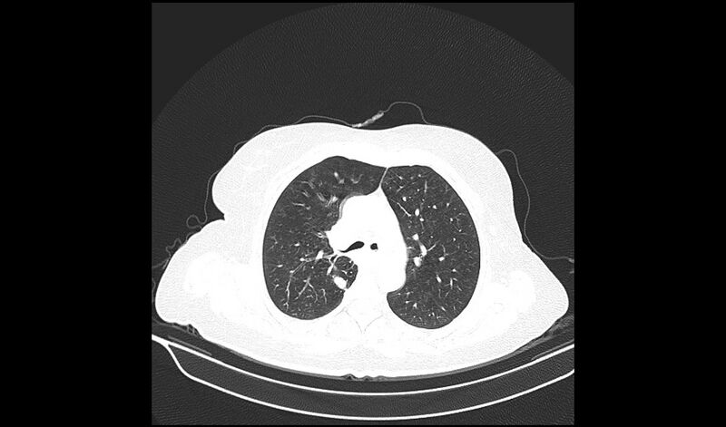 File:Acquired tracheo-esophageal fistula (Radiopaedia 51356-57103 Axial lung window 16).jpg