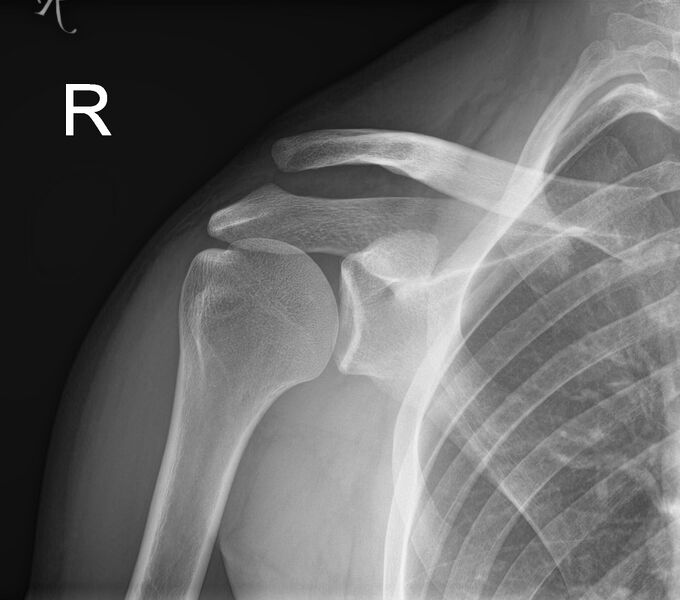 File:Acromioclavicular joint injury - Rockwood III (Radiopaedia 60196-67799 AP 1).jpg