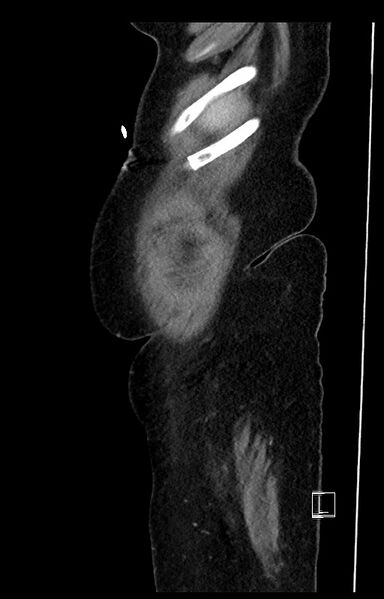 File:Active Crohn disease (Radiopaedia 59394-66750 Sagittal C+ portal venous phase 54).jpg