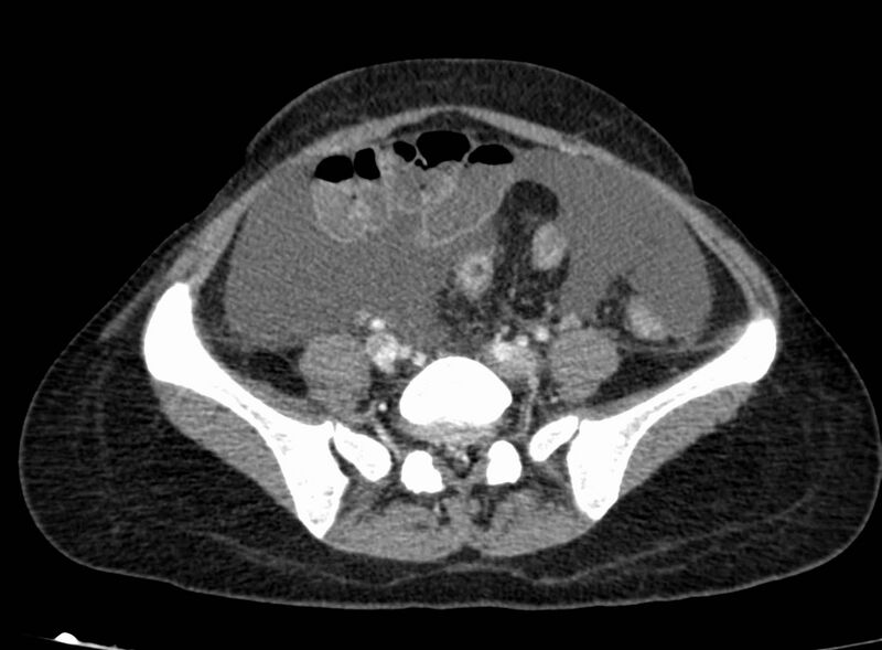 File:Acute Budd-Chiari syndrome (Radiopaedia 60858-68638 Axial C+ portal venous phase 215).jpg