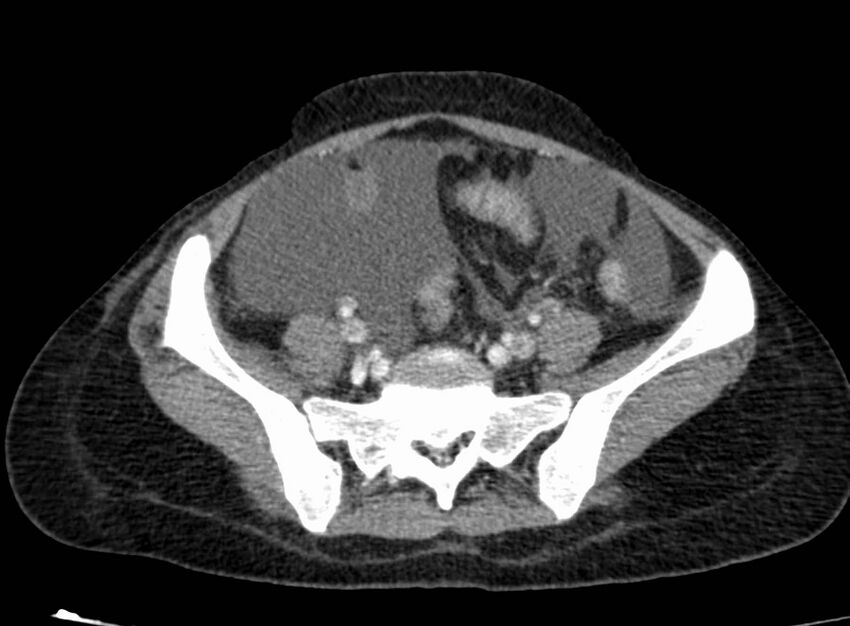 Acute Budd-Chiari syndrome (Radiopaedia 60858-68638 Axial C+ portal venous phase 223).jpg