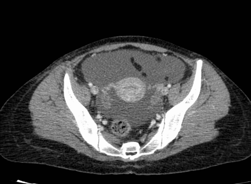 File:Acute Budd-Chiari syndrome (Radiopaedia 60858-68638 Axial C+ portal venous phase 248).jpg