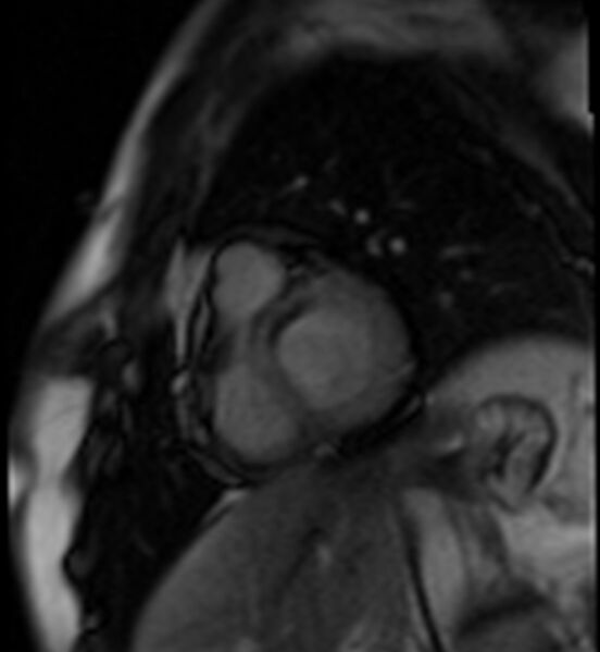 File:Acute anteroseptal myocardial infarction (Radiopaedia 68409-77945 Short axis (basal) Perfusion 17).jpg