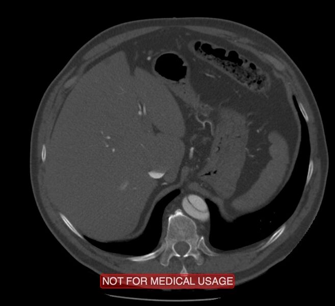 File:Acute aortic dissection - Stanford type A (Radiopaedia 40661-43285 Axial C+ arterial phase 75).jpg