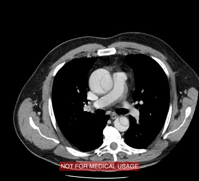 File:Acute aortic dissection - Stanford type A (Radiopaedia 40661-43285 Axial C+ portal venous phase 19).jpg