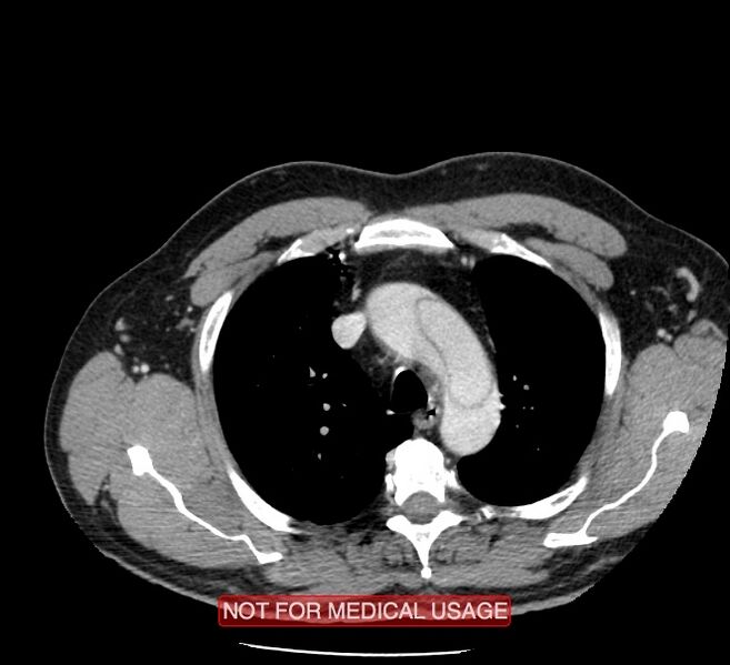 File:Acute aortic dissection - Stanford type A (Radiopaedia 40661-43285 Axial C+ portal venous phase 3).jpg