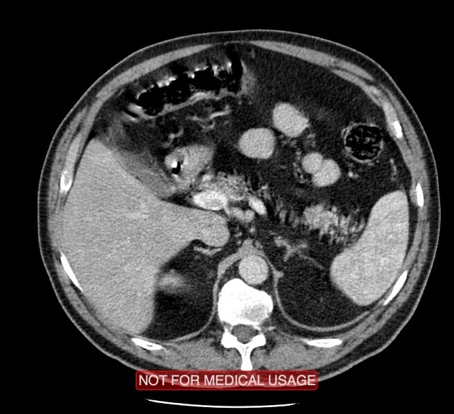File:Acute aortic dissection - Stanford type A (Radiopaedia 40661-43285 Axial C+ portal venous phase 81).jpg