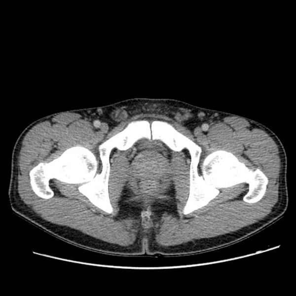 File:Acute appendicitis (Radiopaedia 27049-27227 Axial C+ portal venous phase 76).jpg