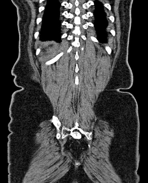 File:Acute appendicitis (Radiopaedia 58627-65818 Coronal non-contrast 58).jpg