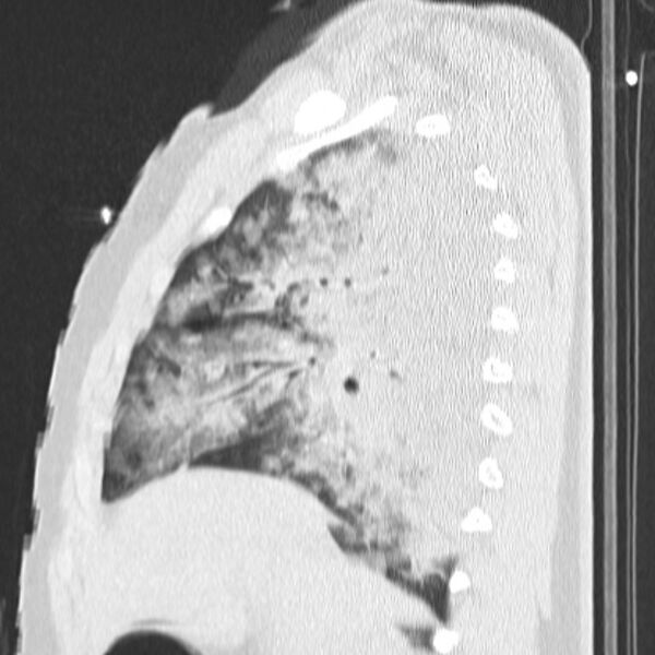 File:Acute aspiration pneumonitis (Radiopaedia 33605-34703 Sagittal lung window 33).jpg