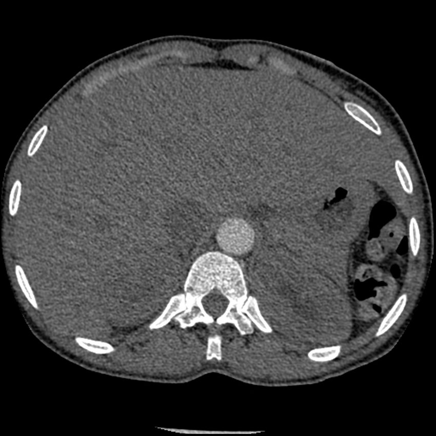Acute chest syndrome - sickle cell disease (Radiopaedia 42375-45499 Axial C+ CTPA 188).jpg
