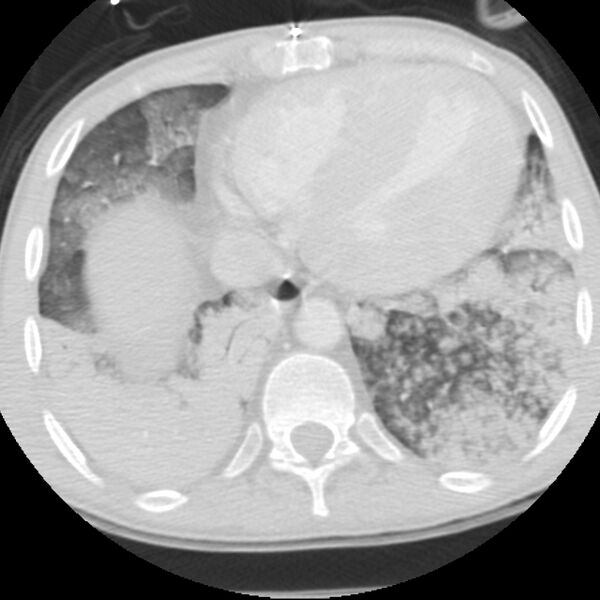 File:Acute diffuse alveolar hemorrhage (Radiopaedia 41323-44158 Axial lung window 49).jpg
