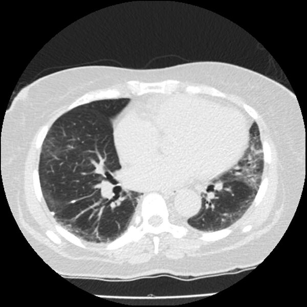File:Acute interstitial pneumonitis (Radiopaedia 45404-49444 Axial lung window 64).jpg