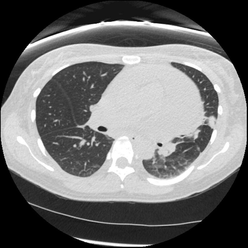 Acute lupus nephritis (Radiopaedia 45832-50107 Axial lung window 41).jpg
