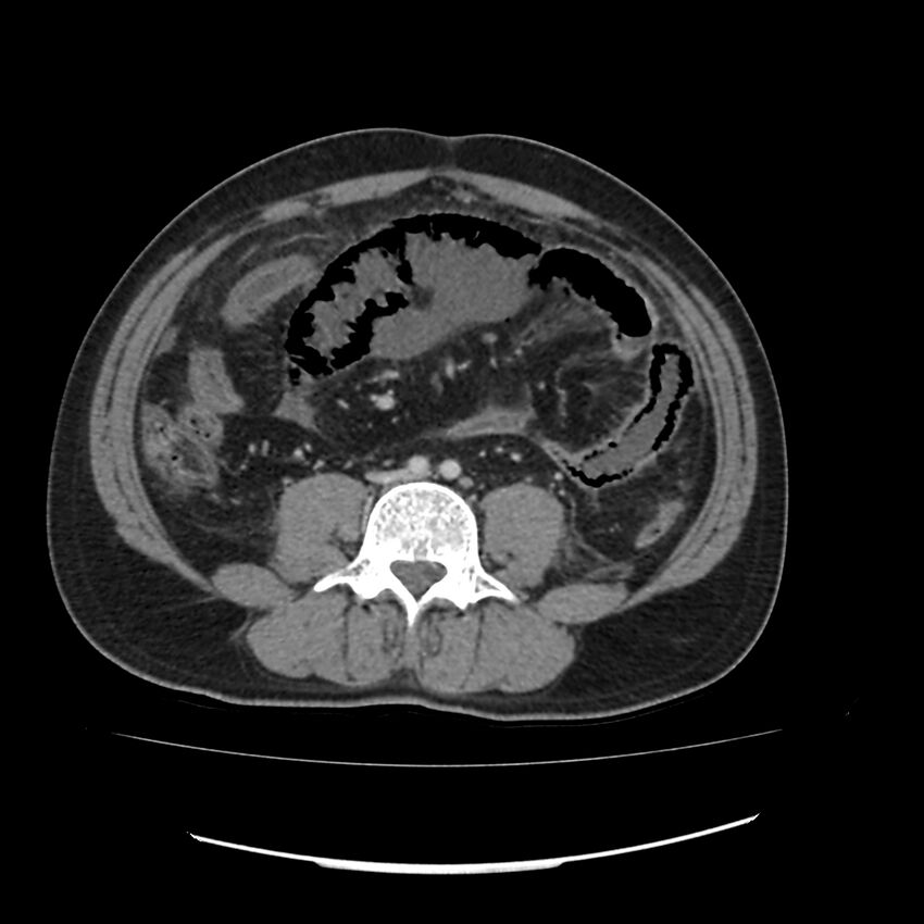 Acute mesenteric ischemia - superior mesenteric artery thrombosis (Radiopaedia 73947-84776 Axial C+ portal venous phase 95).jpg