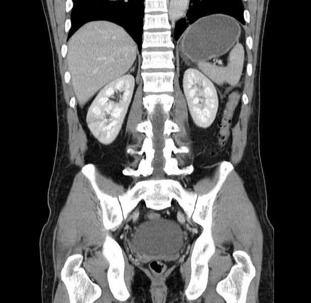 File:Acute pancreatitis (Radiopaedia 22572-22596 Coronal C+ portal venous phase 38).jpg