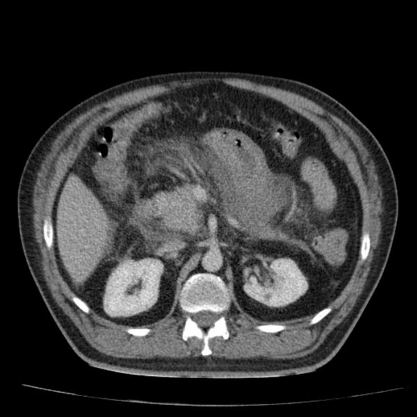 File:Acute pancreatitis (Radiopaedia 26663-26813 Axial C+ portal venous phase 31).jpg