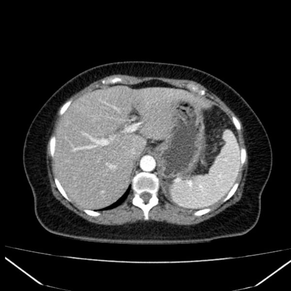 File:Acute pancreatitis - Balthazar C (Radiopaedia 26569-26714 Axial C+ arterial phase 19).jpg