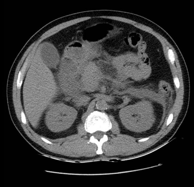 File:Acute pancreatitis - Balthazar E (Radiopaedia 23080-23110 Axial non-contrast 25).jpg