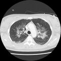 Acute pulmonary edema on CT (Radiopaedia 33582-34672 Axial lung window 16).jpg