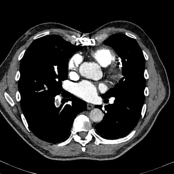 File:Acute pulmonary embolism (Radiopaedia 81677-95570 Axial C+ CTPA 64).jpg