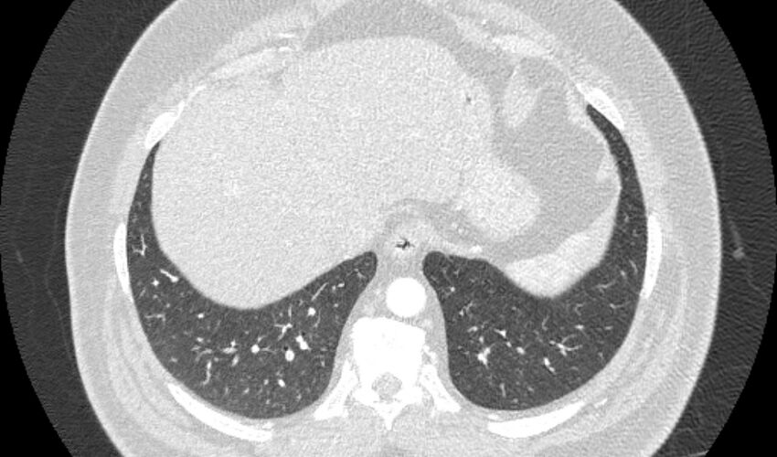 Acute pulmonary embolism with pulmonary infarcts (Radiopaedia 77688-89908 Axial lung window 108).jpg