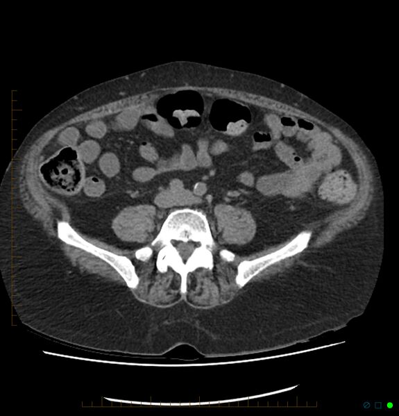 File:Acute renal failure post IV contrast injection- CT findings (Radiopaedia 47815-52557 Axial non-contrast 53).jpg