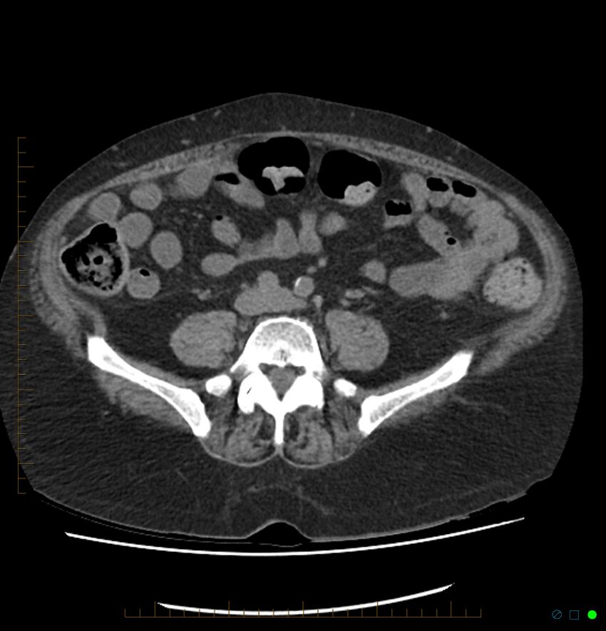 Acute renal failure post IV contrast injection- CT findings (Radiopaedia 47815-52557 Axial non-contrast 53).jpg