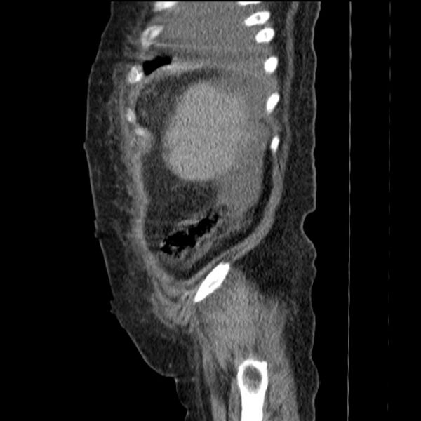 File:Acute tubular necrosis (Radiopaedia 28077-28334 H 15).jpg