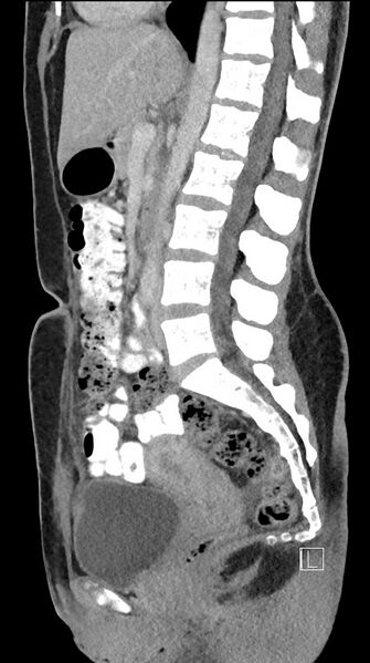 File:Acute uncomplicated appendicitis (Radiopaedia 61374-69304 Sagittal C+ portal venous phase 51).jpg
