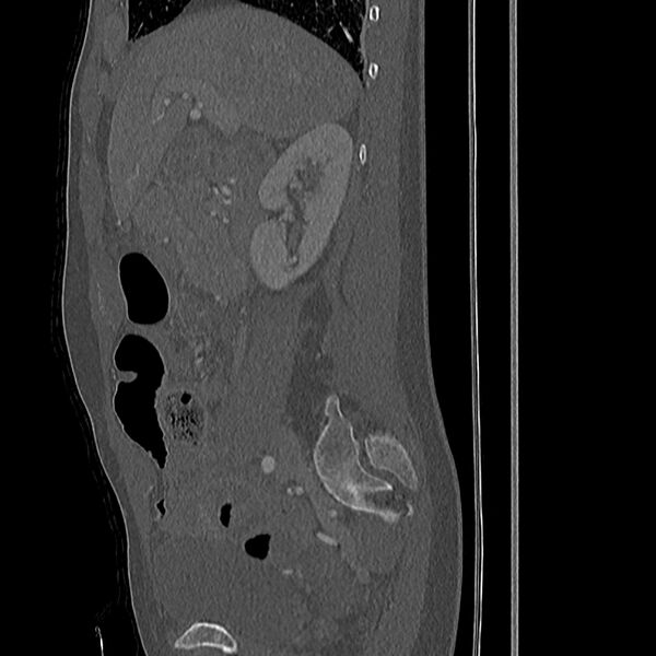 File:Acute vertebral body compression fractures (Radiopaedia 31757-32693 Sagittal bone window 50).jpg