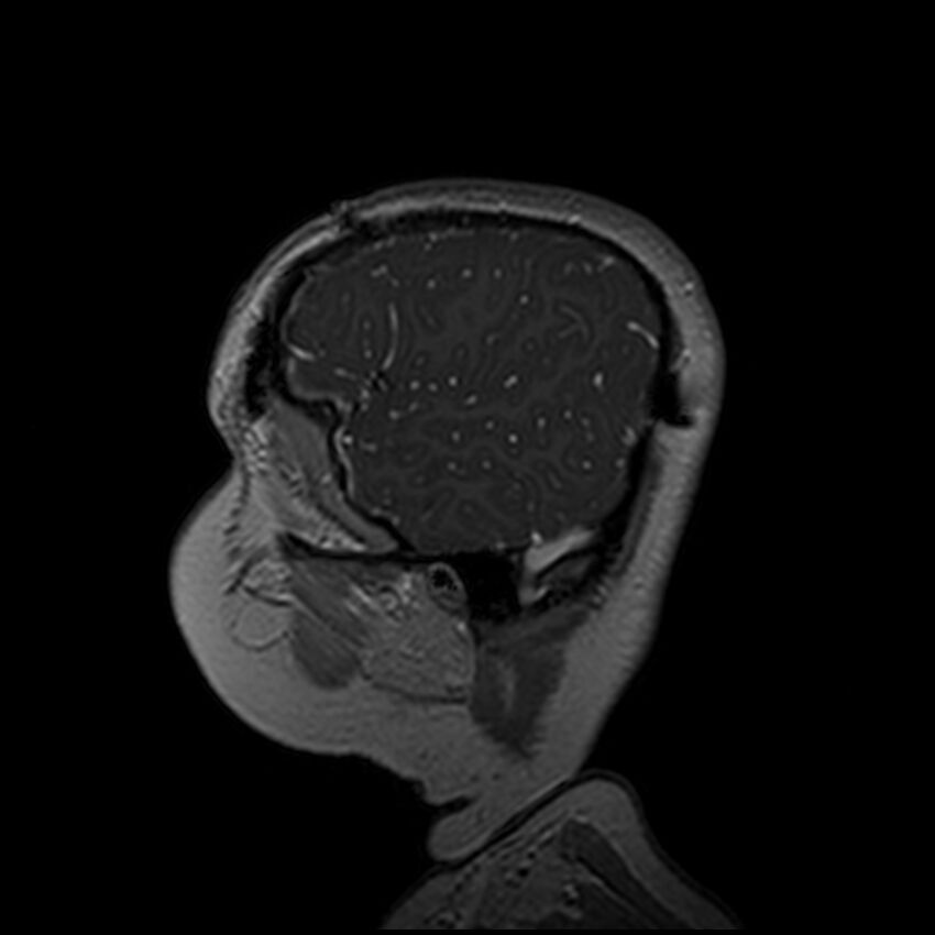 Adamantinomatous craniopharyngioma (Radiopaedia 77407-89529 H 105).jpg