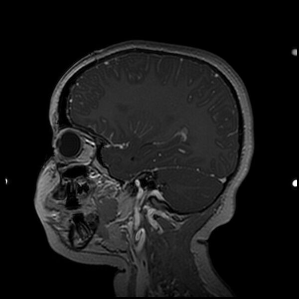 File:Adamantinomatous craniopharyngioma (Radiopaedia 77407-89529 H 83).jpg