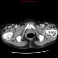 Adenocarcinoma of the colon (Radiopaedia 8191-9039 Axial liver window 76).jpg