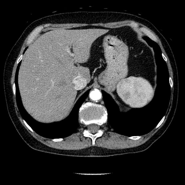 File:Adenocarcinoma of the lung (Radiopaedia 41015-43755 Axial C+ portal venous phase 111).jpg