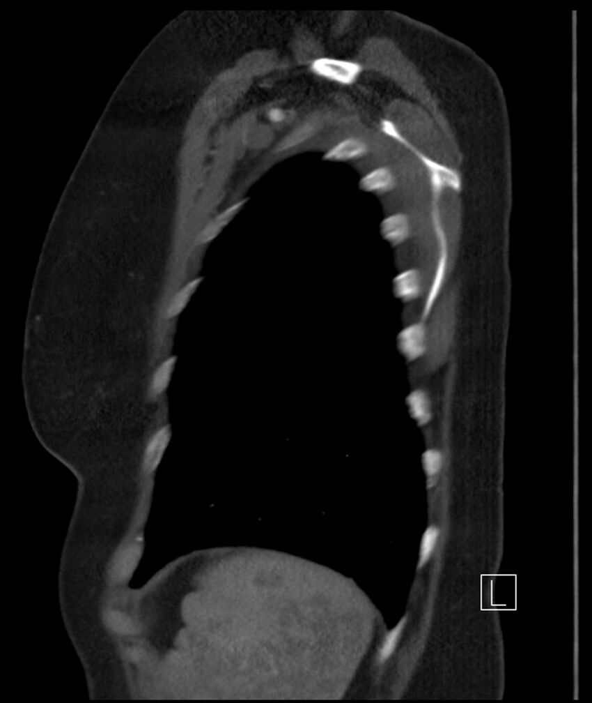 Adenocarcinoma of the lung (Radiopaedia 44205-47803 Sagittal C+ portal venous phase 8).jpg