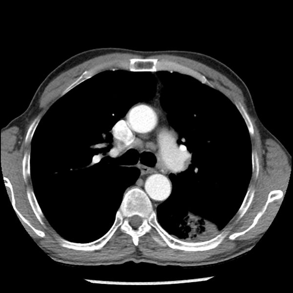 File:Adenocarcinoma of the lung - micropapillary predominant (Radiopaedia 42446-45563 Axial C+ portal venous phase 28).jpg