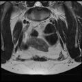 Adenoma malignum of the cervix (Radiopaedia 24460-24765 Coronal T2 3).jpg